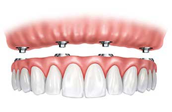 Fixed Removable Dentures on implant