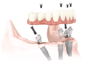 aal-on-4 dental implant