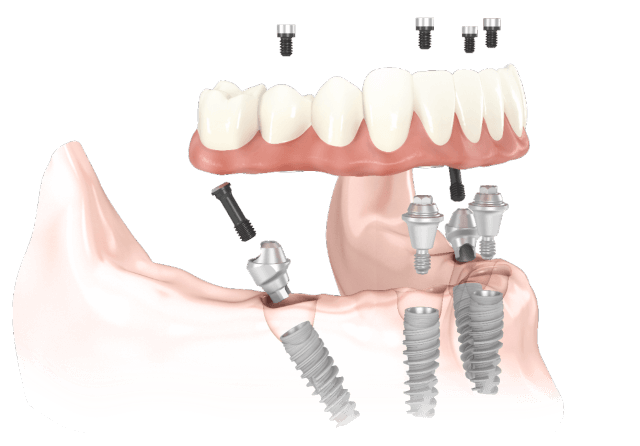 aal-on-4 dental implant