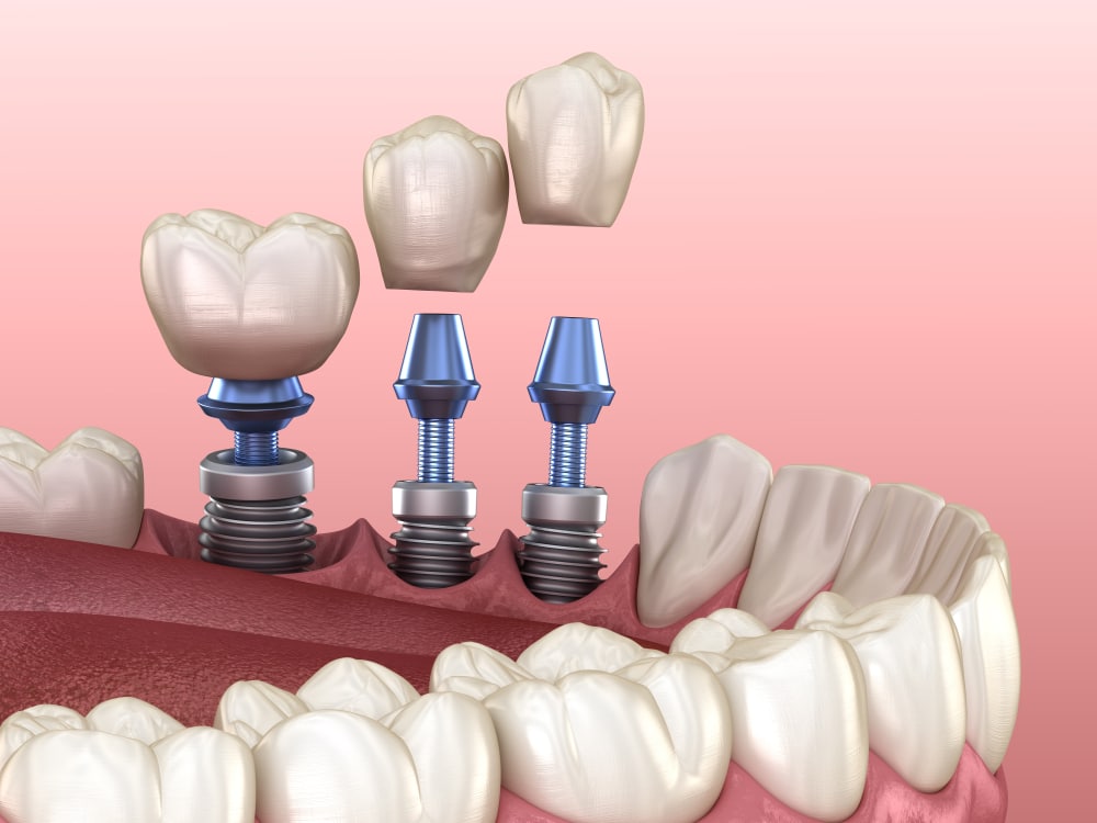 Dental Implants COST in Vancouver