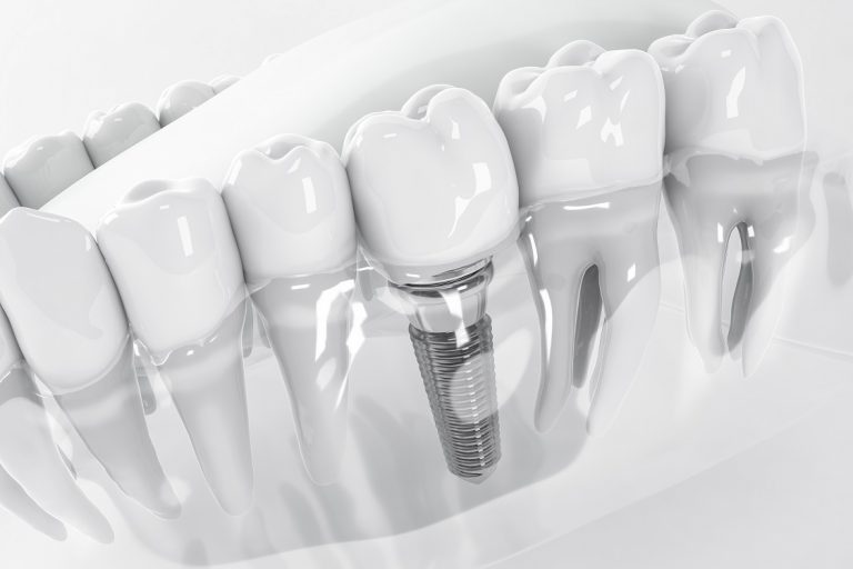 dental implants whitening